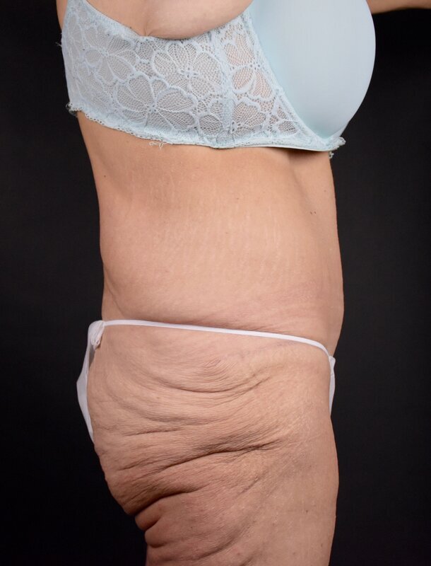 Abdominoplasty w/out Lipo Before & After Image