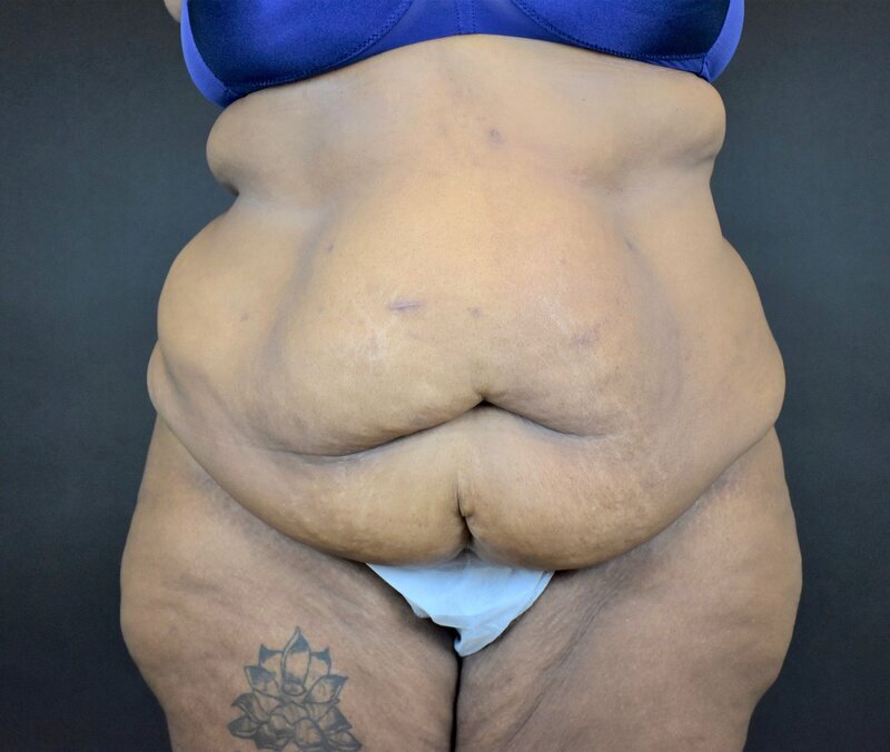 Abdominoplasty w/out Lipo Before & After Image