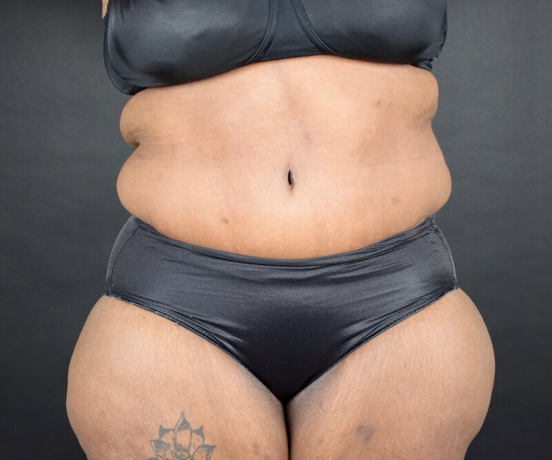 Abdominoplasty w/out Lipo Before & After Image