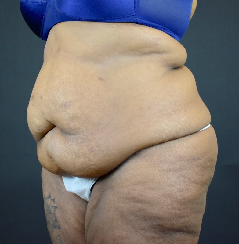 Abdominoplasty w/out Lipo Before & After Image