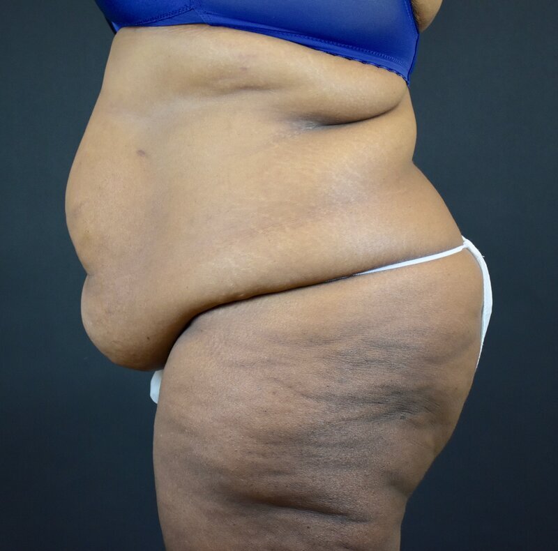 Abdominoplasty w/out Lipo Before & After Image