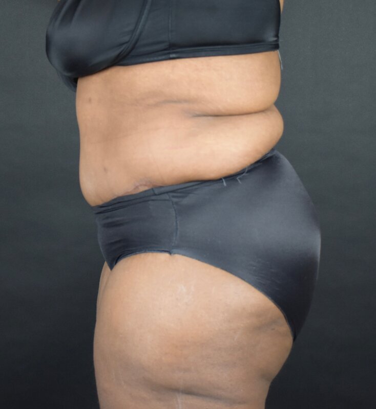 Abdominoplasty w/out Lipo Before & After Image