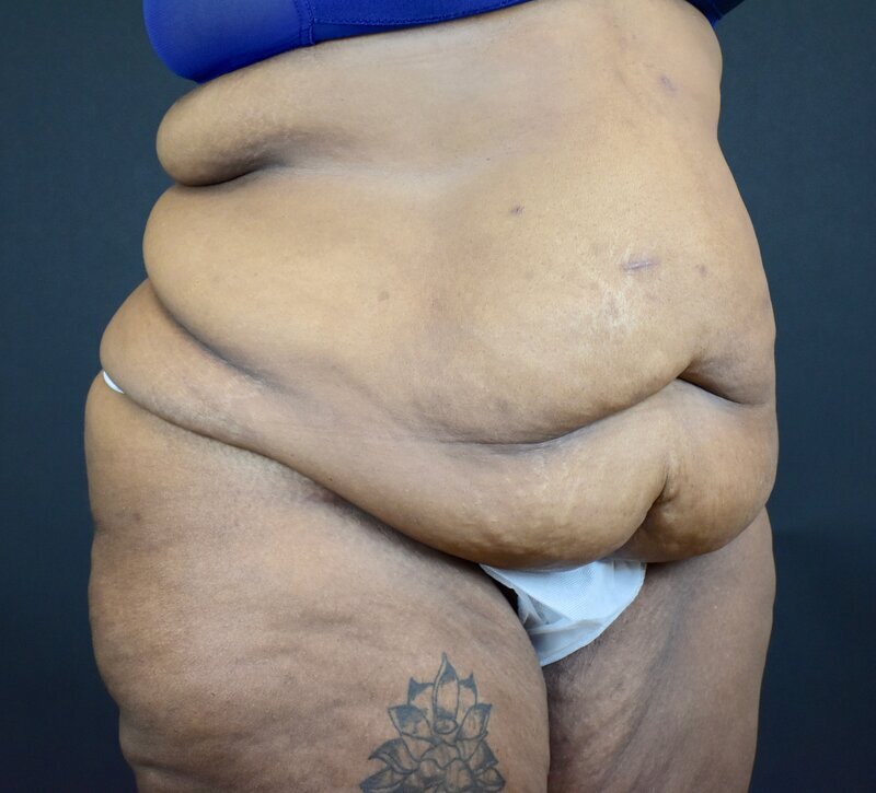 Abdominoplasty w/out Lipo Before & After Image