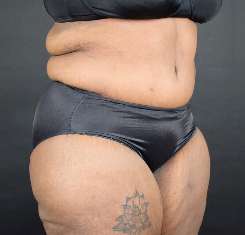 Abdominoplasty w/out Lipo Before & After Image