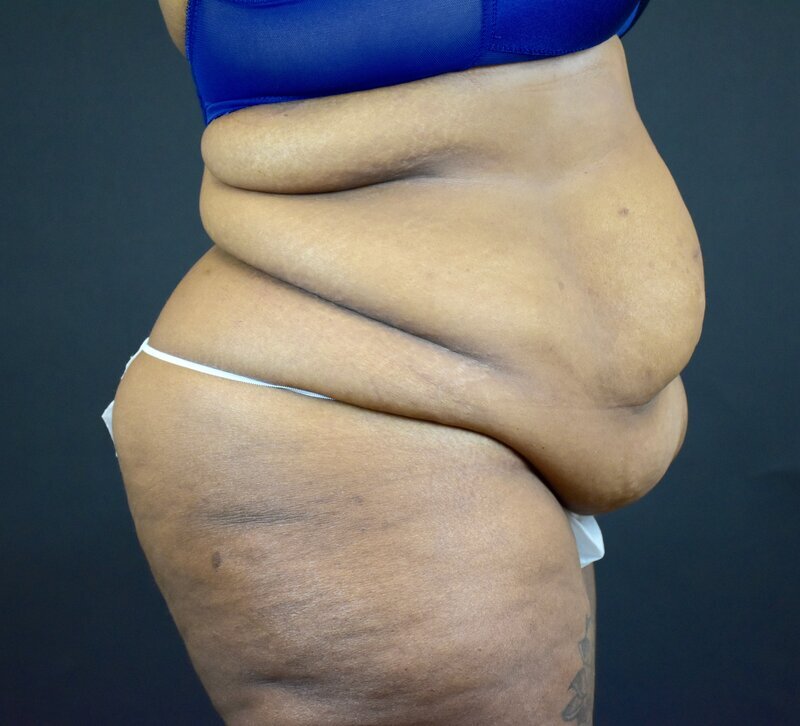 Abdominoplasty w/out Lipo Before & After Image