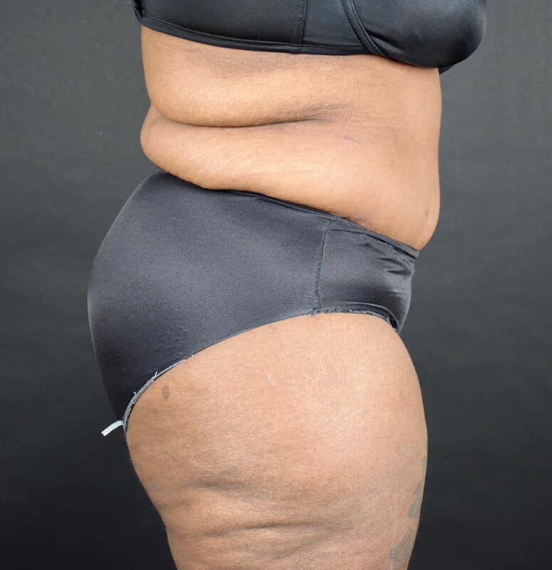 Abdominoplasty w/out Lipo Before & After Image