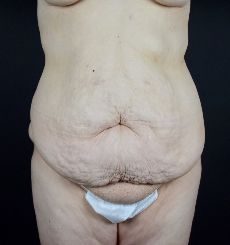 Abdominoplasty w/out Lipo Before & After Image
