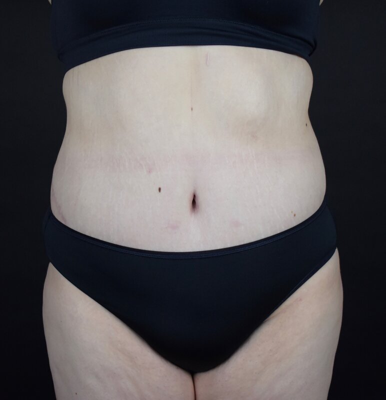 Abdominoplasty w/out Lipo Before & After Image