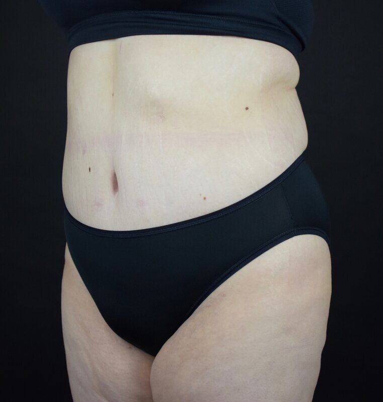 Abdominoplasty w/out Lipo Before & After Image