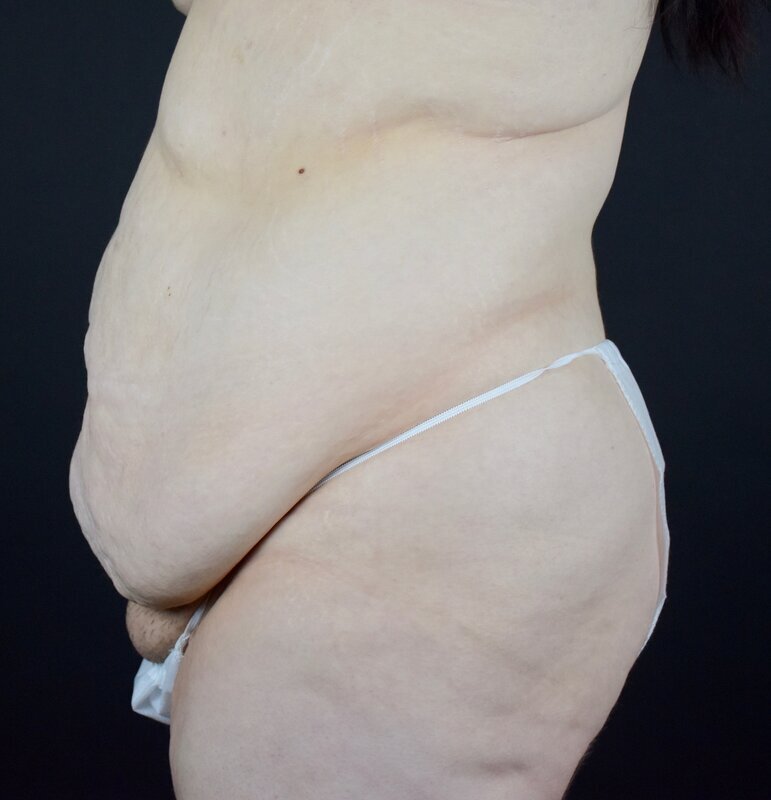 Abdominoplasty w/out Lipo Before & After Image