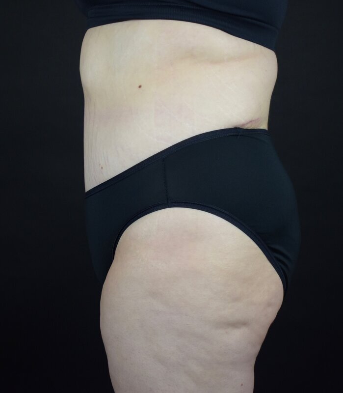 Abdominoplasty w/out Lipo Before & After Image