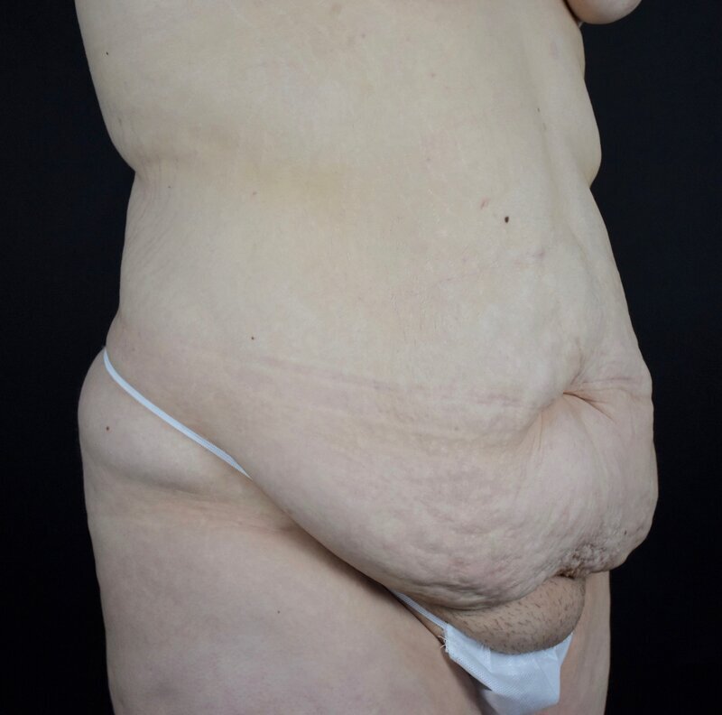 Abdominoplasty w/out Lipo Before & After Image