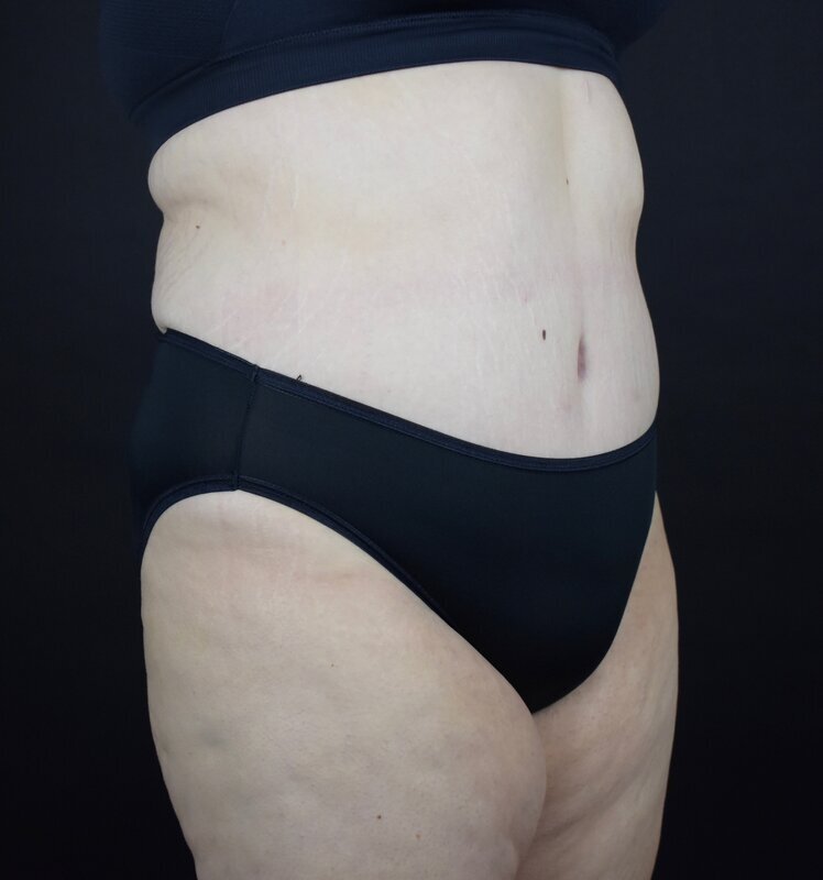 Abdominoplasty w/out Lipo Before & After Image