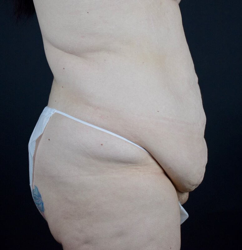 Abdominoplasty w/out Lipo Before & After Image