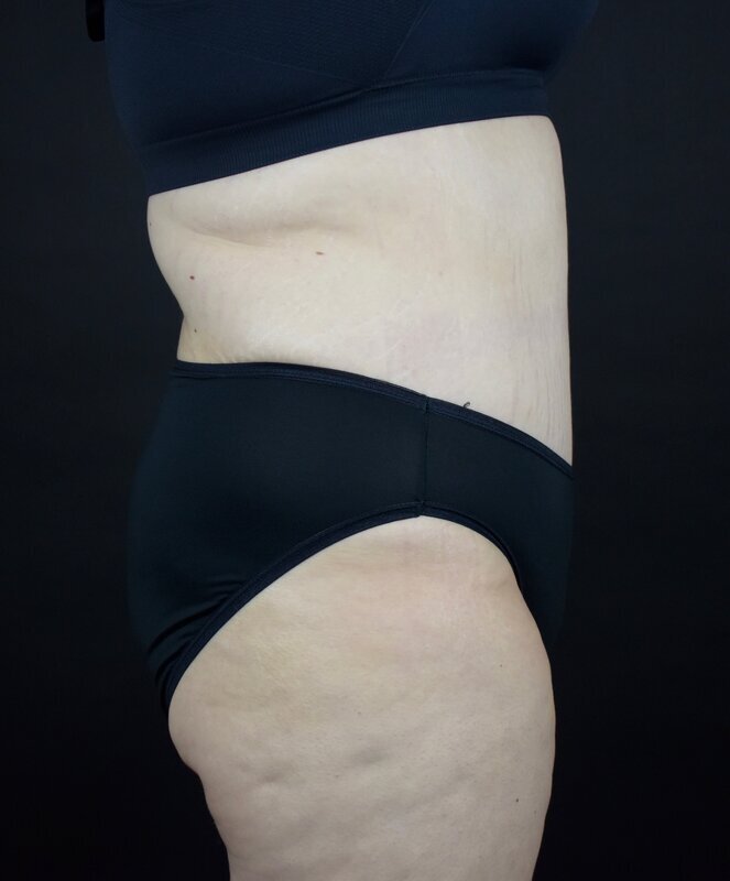 Abdominoplasty w/out Lipo Before & After Image