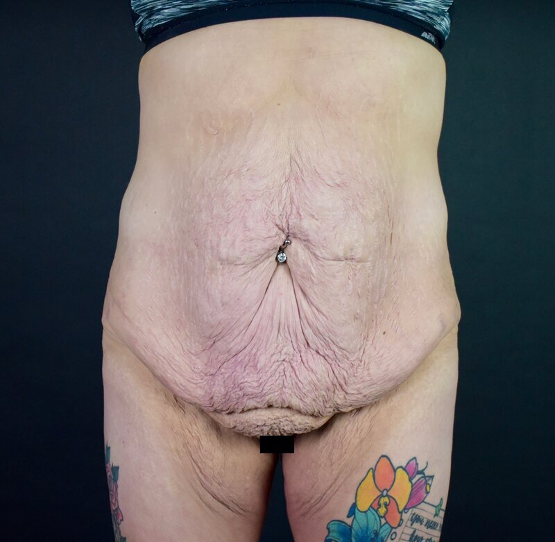 Abdominoplasty w/out Lipo Before & After Image