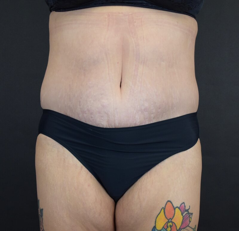 Abdominoplasty w/out Lipo Before & After Image