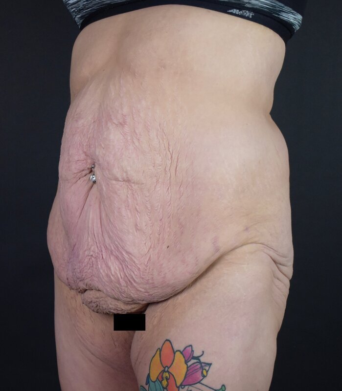 Abdominoplasty w/out Lipo Before & After Image