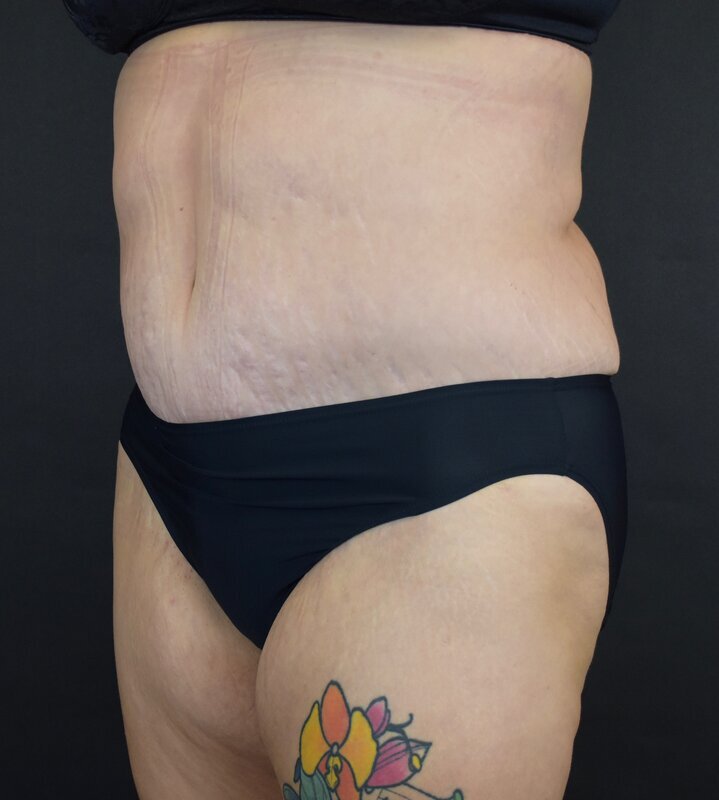 Abdominoplasty w/out Lipo Before & After Image