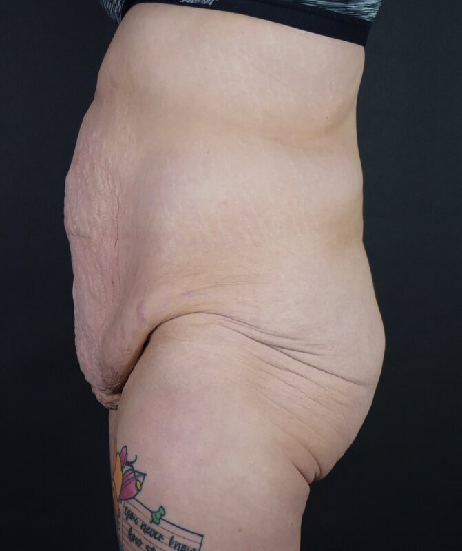 Abdominoplasty w/out Lipo Before & After Image