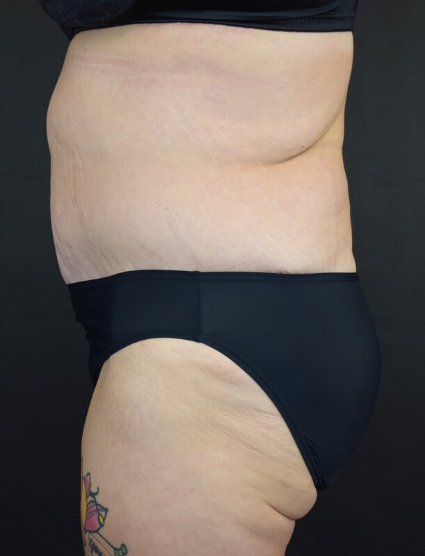 Abdominoplasty w/out Lipo Before & After Image