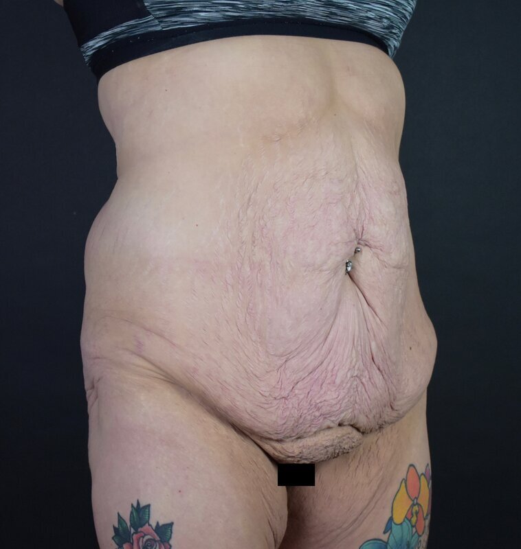 Abdominoplasty w/out Lipo Before & After Image