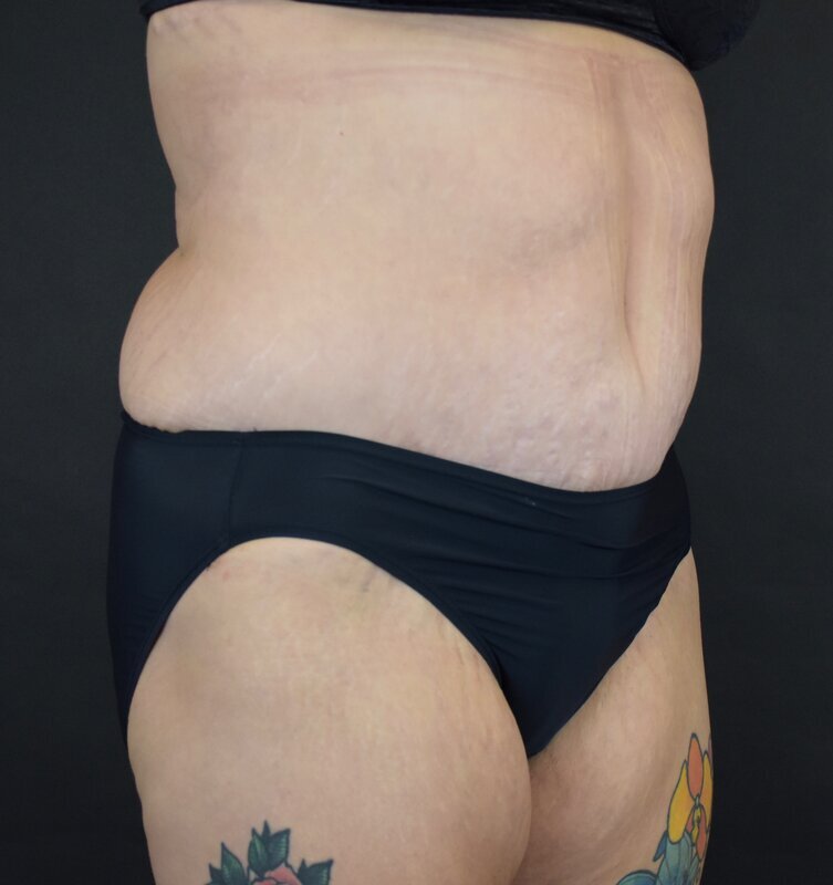 Abdominoplasty w/out Lipo Before & After Image