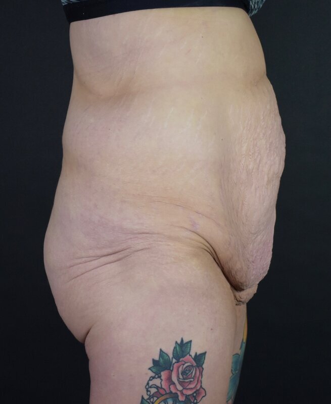 Abdominoplasty w/out Lipo Before & After Image