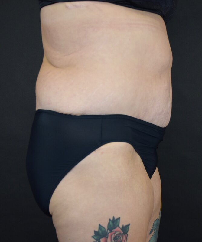 Abdominoplasty w/out Lipo Before & After Image