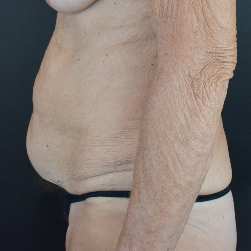 Abdominoplasty w/out Lipo Before & After Image