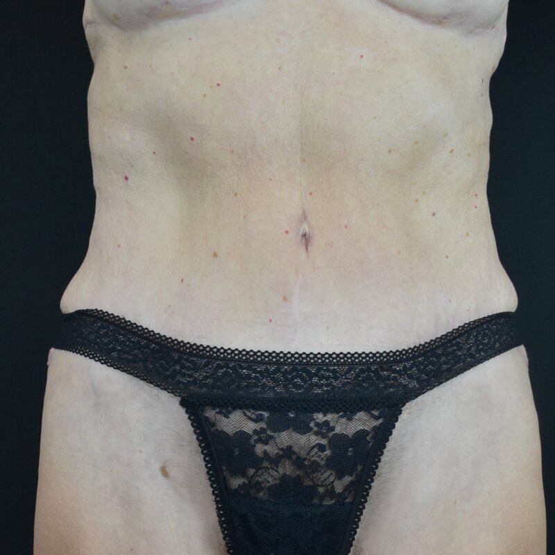 Abdominoplasty w/out Lipo Before & After Image