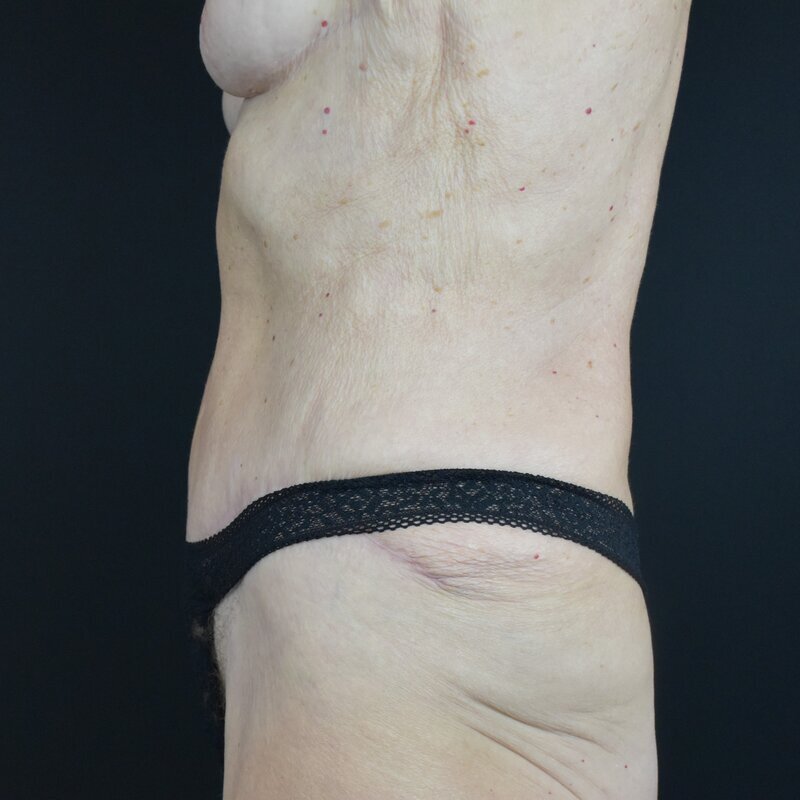 Abdominoplasty w/out Lipo Before & After Image