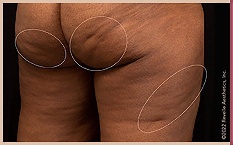 Aveli Cellulite Reduction Before & After Image