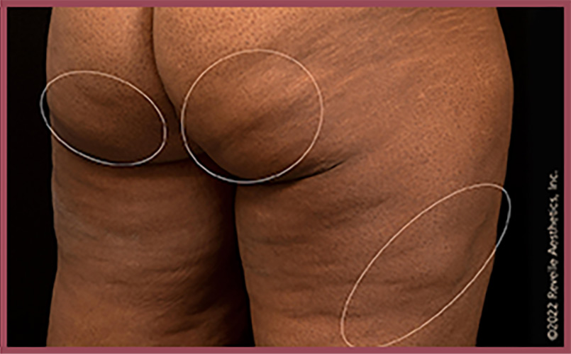 Aveli Cellulite Reduction Before & After Image