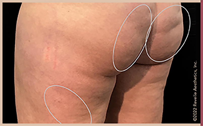 Aveli Cellulite Reduction Before & After Image