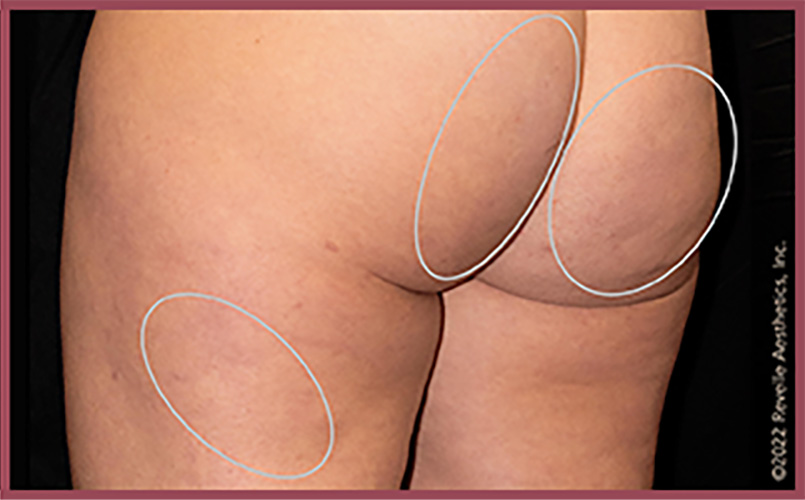 Aveli Cellulite Reduction Before & After Image