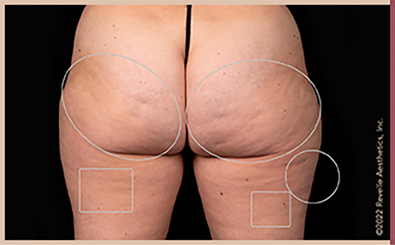 Aveli Cellulite Reduction Before & After Image