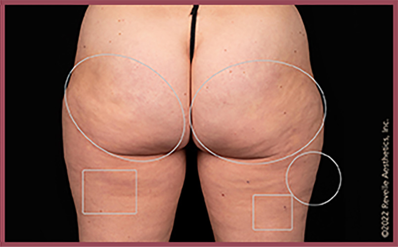 Aveli Cellulite Reduction Before & After Image