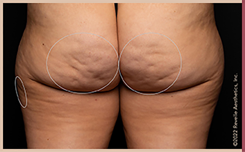 Aveli Cellulite Reduction Before & After Image