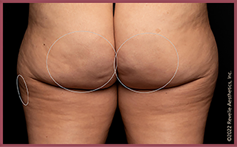 Aveli Cellulite Reduction Before & After Image