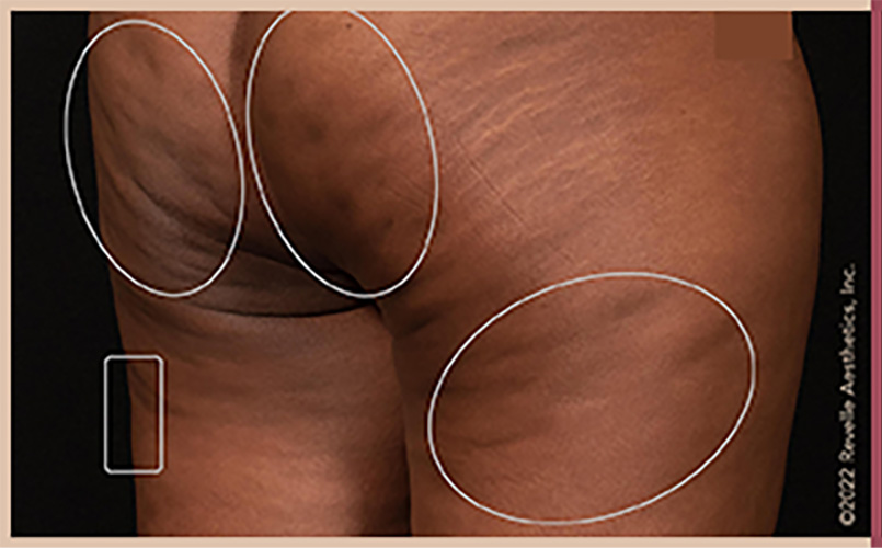 Aveli Cellulite Reduction Before & After Image