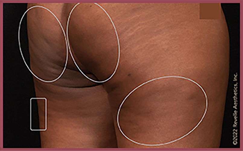 Aveli Cellulite Reduction Before & After Image