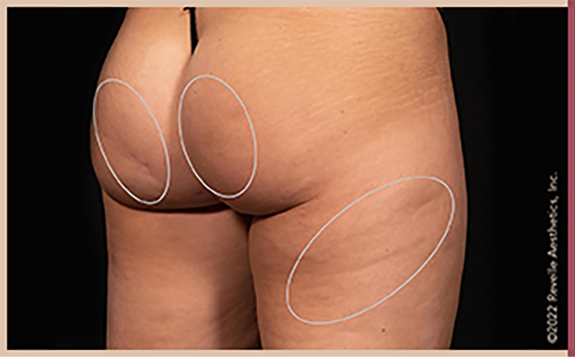 Aveli Cellulite Reduction Before & After Image