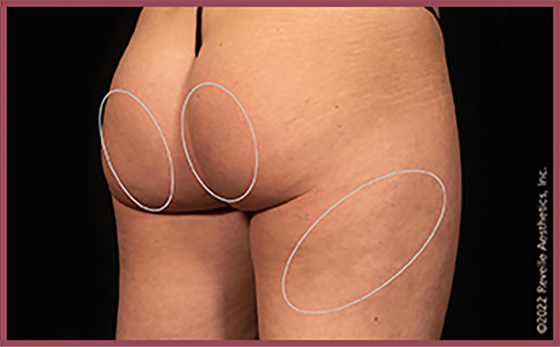 Aveli Cellulite Reduction Before & After Image