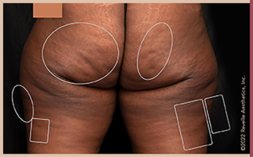 Aveli Cellulite Reduction Before & After Image