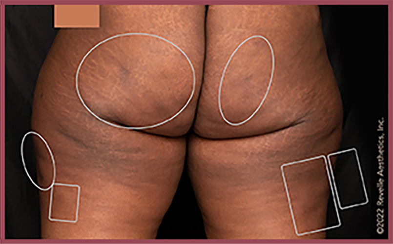 Aveli Cellulite Reduction Before & After Image