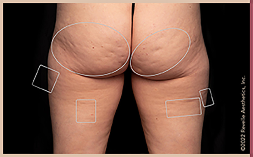 Aveli Cellulite Reduction Before & After Image