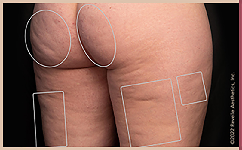 Aveli Cellulite Reduction Before & After Image