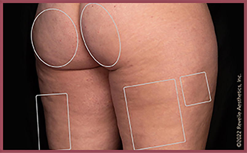 Aveli Cellulite Reduction Before & After Image