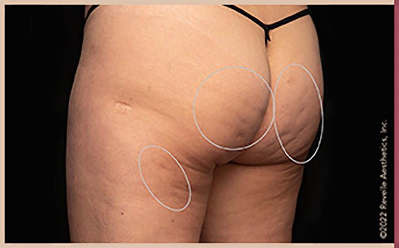 Aveli Cellulite Reduction Before & After Image